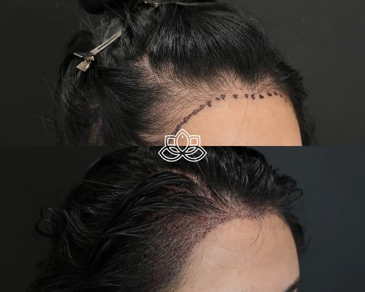 Hair Transplant for Women 2