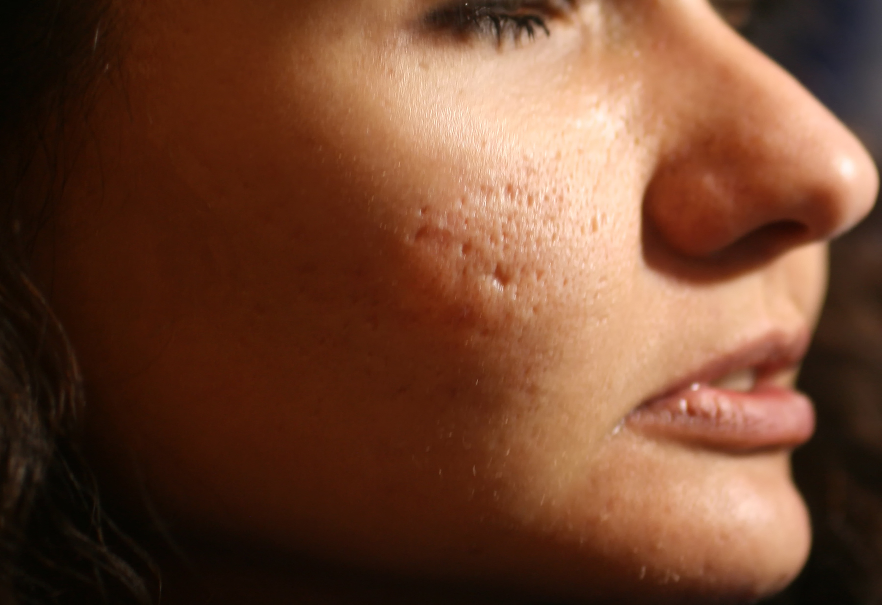Inflamed skin of the face in pimples and acne. Keloid scars from acne.