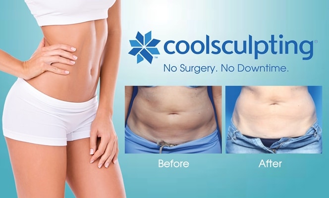 coolsculpting arm fat tijuana