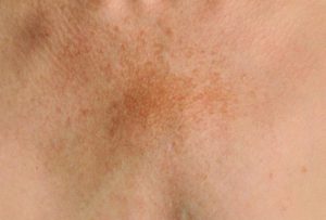 melasma and microneedling