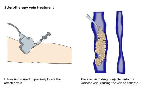 Sclerotherapy Veins