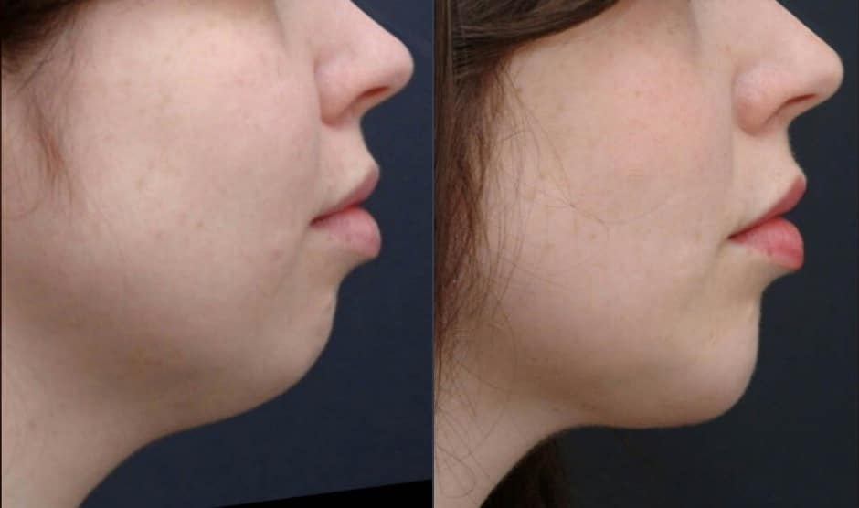 weak chin filler tiuana