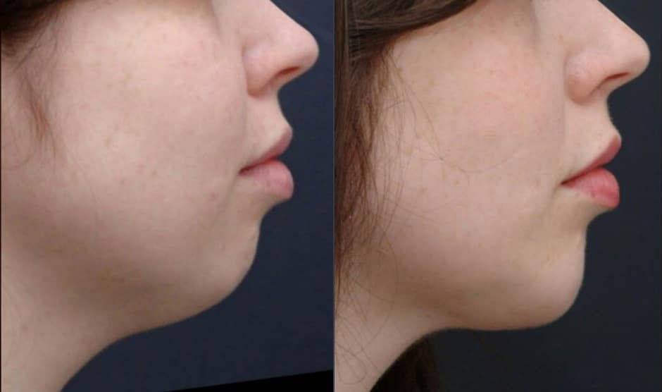 Weak Chin Treatment In Tijuana Dr Sergio Verduzco Chin Fillers For 