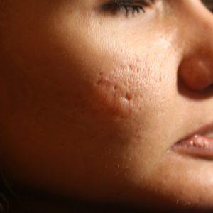 Inflamed skin of the face in pimples and acne. Keloid scars from acne.