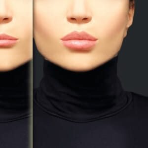 lip-fillers-o3mqgqi71nd873mqipg4qy7r7cmo9fg0xqhjaqkcl4